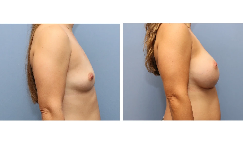 Breast augmentation before and after, side view showing increased volume and projection