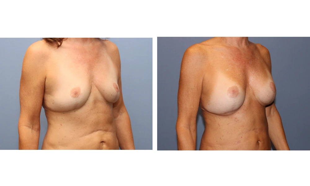 Breast augmentation before and after, frontal view