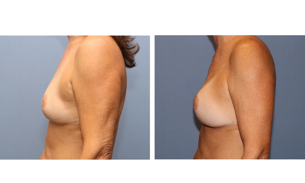 Breast augmentation before and after, side view displaying improved profile and upper pole fullness