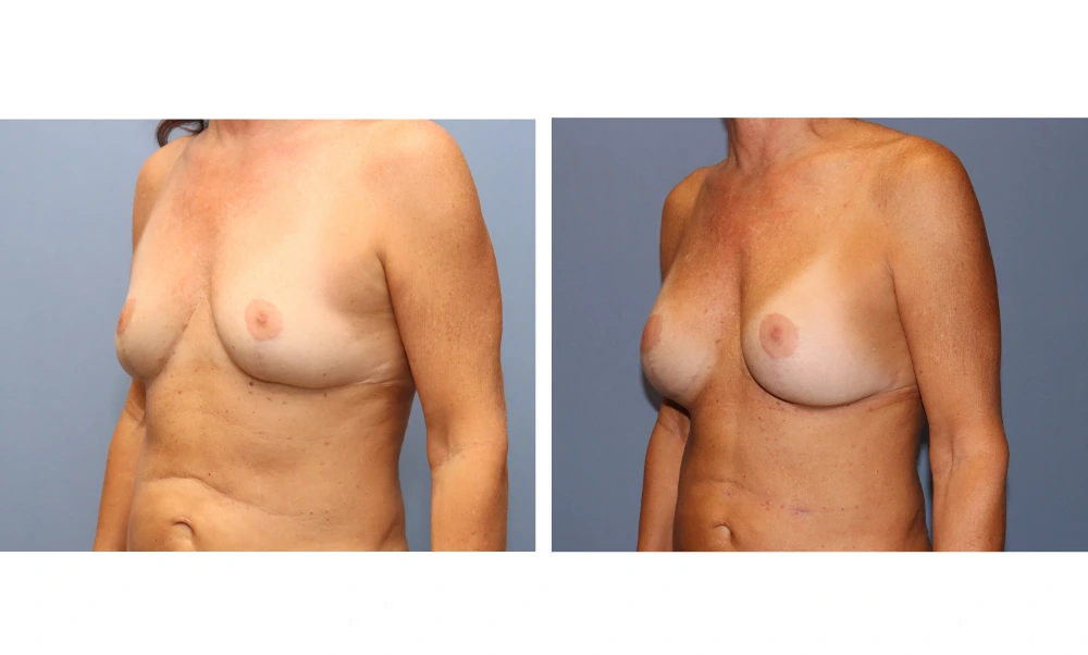 Breast augmentation before and after, angled view showing enhanced volume and natural contour
