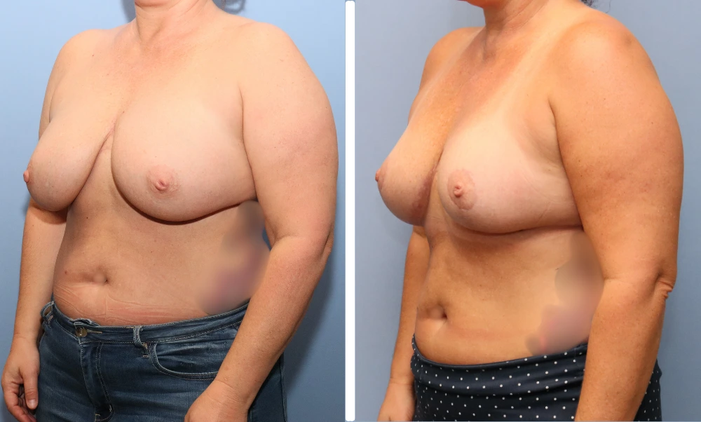 Three-quarter angle before and after breast reduction comparison