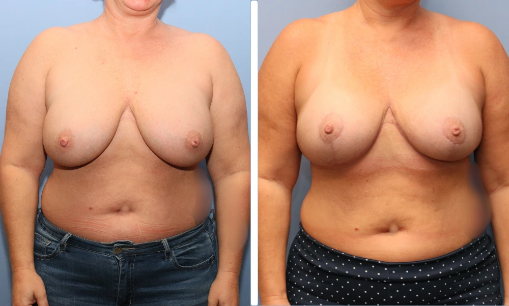Front-facing before and after breast reduction comparison
