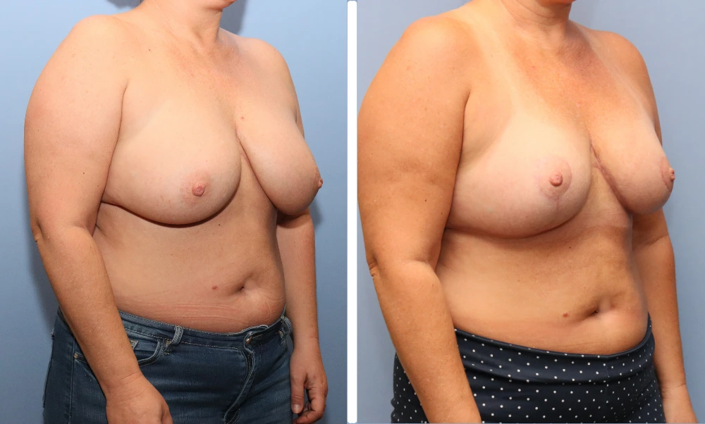 Side profile before and after breast reduction comparison