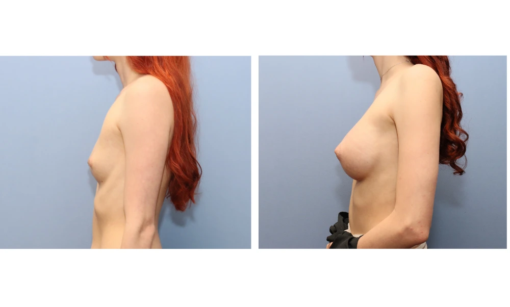 Breast augmentation before and after, side view