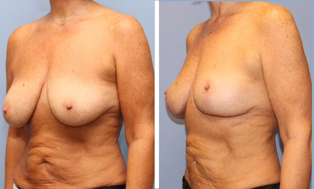 Before and after breast lift with augmentation, oblique views showing improved positioning and volume
