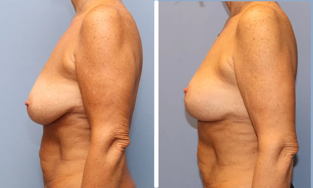 Before and after breast surgery results shown from side profile view