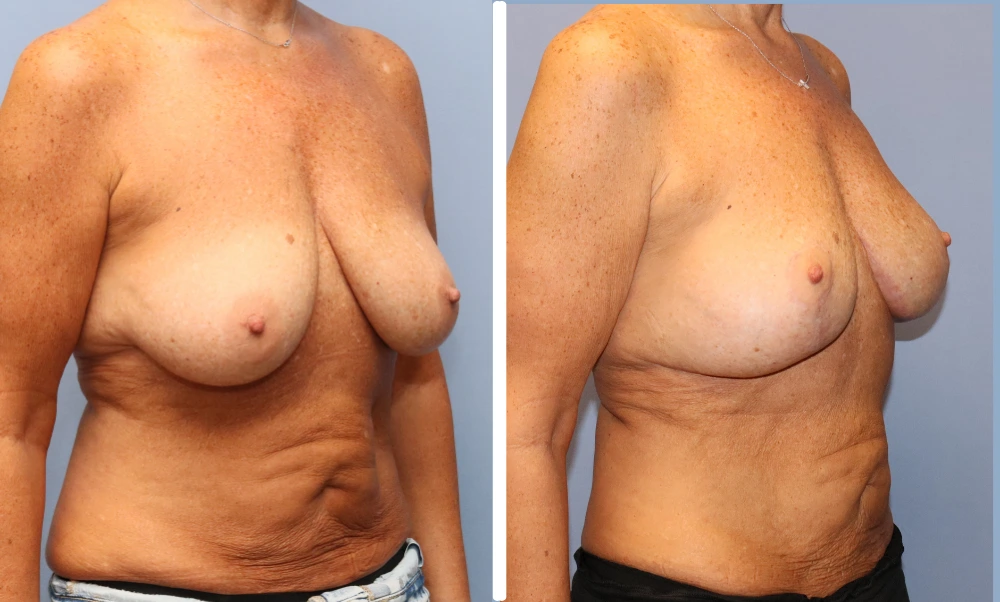 Before and after breast surgery results shown from oblique frontal view