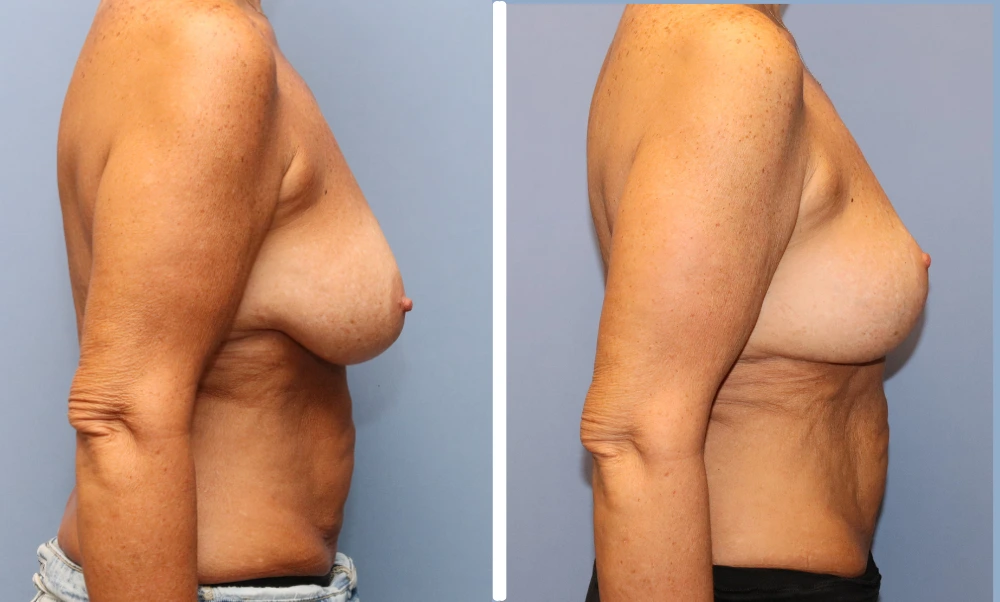 Before and after breast surgery results shown from side view
