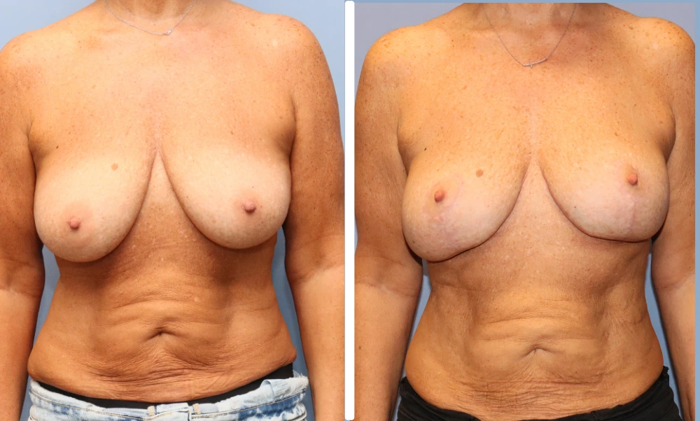 Before and after breast surgery results shown from frontal view