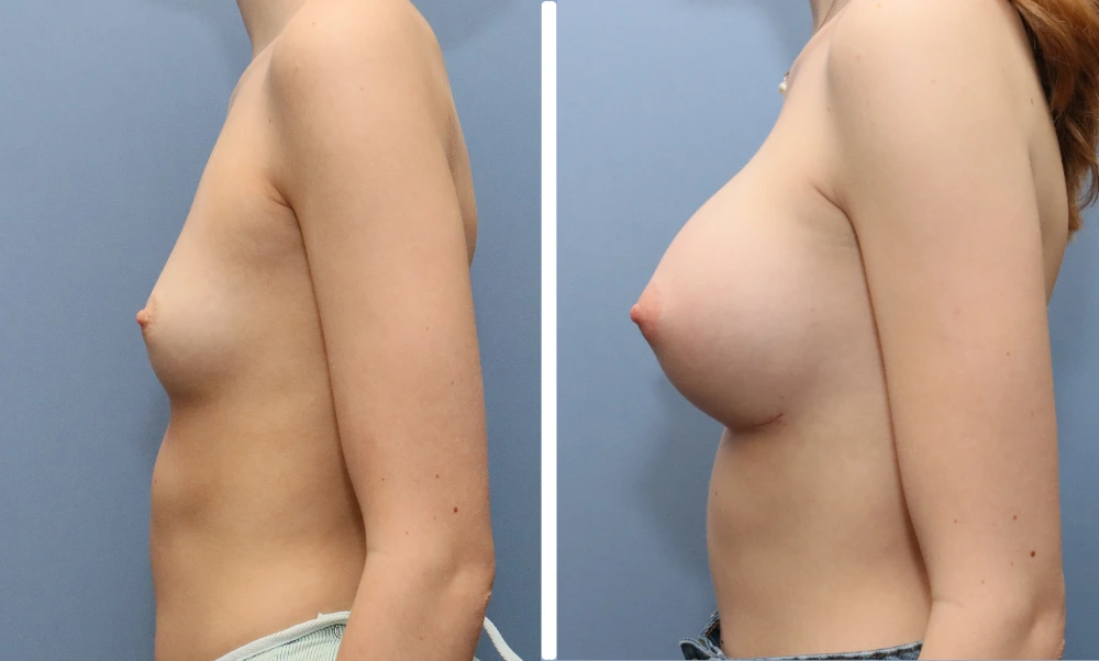 Before and after breast augmentation, side profile view