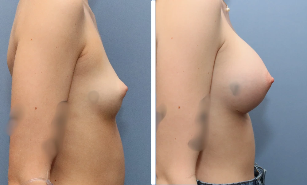 Before and after breast augmentation, side profile view