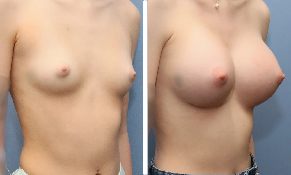 Before and after breast augmentation, frontal and side view