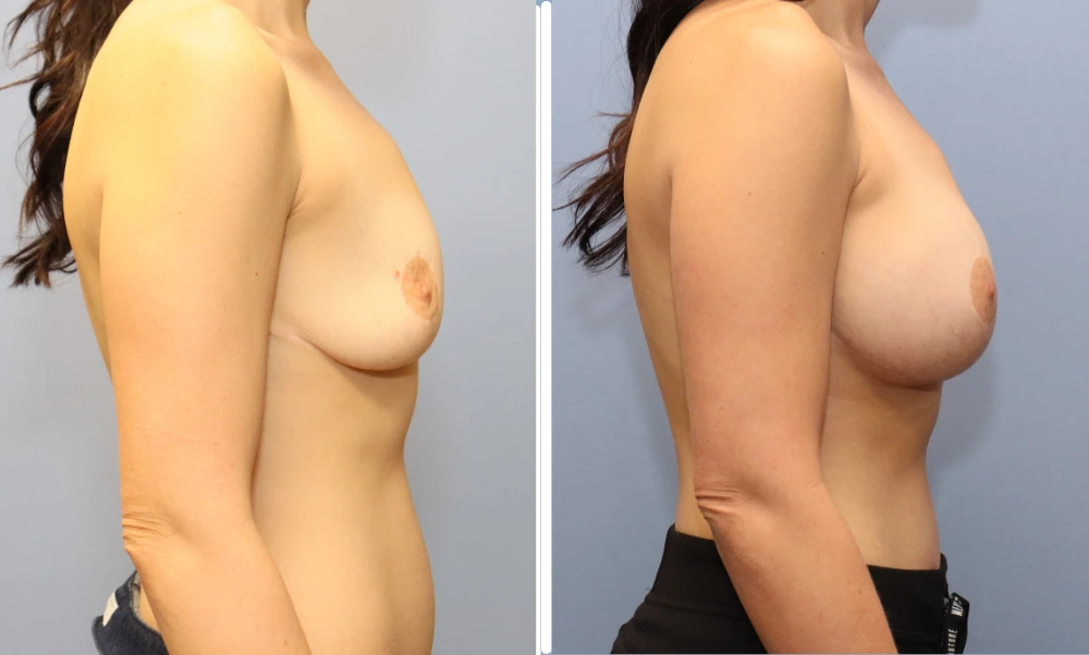 Before and after breast augmentation, side profile views