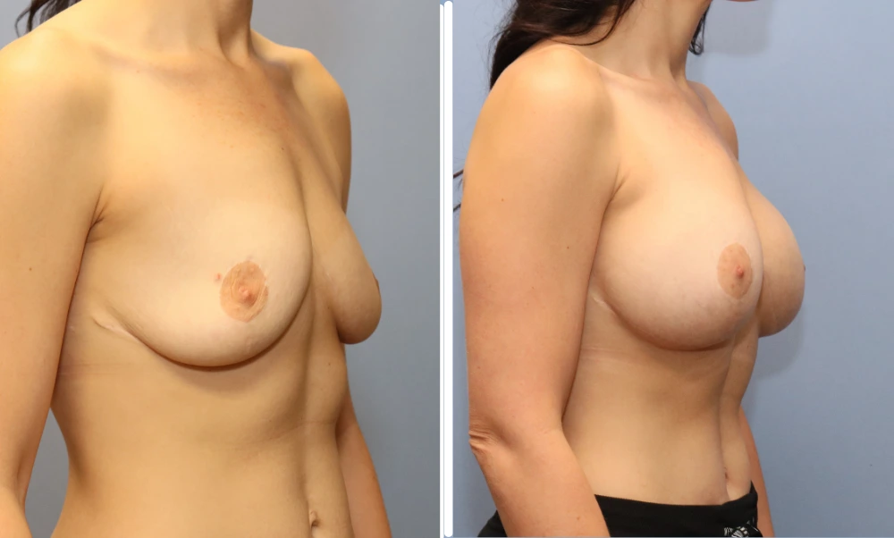 Before and after breast augmentation, frontal and three-quarter views