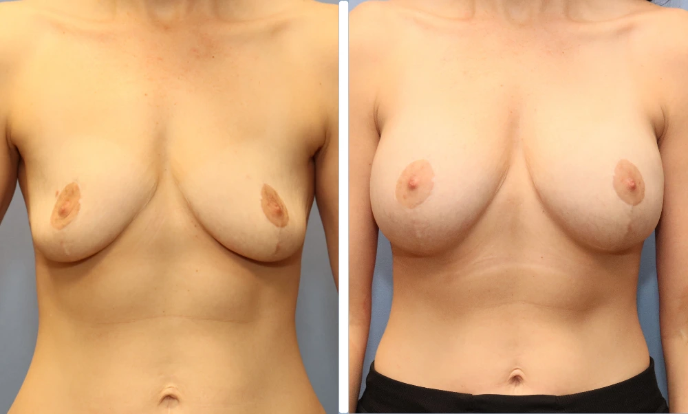 Before and after breast augmentation, front view displaying balanced proportion and lift
