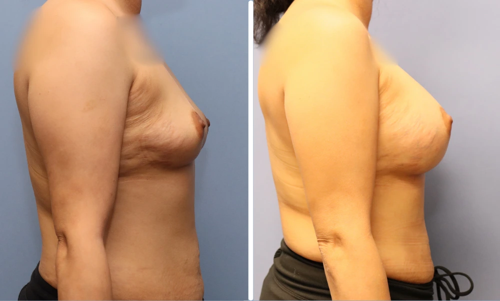 Before and after side profile showing breast augmentation results