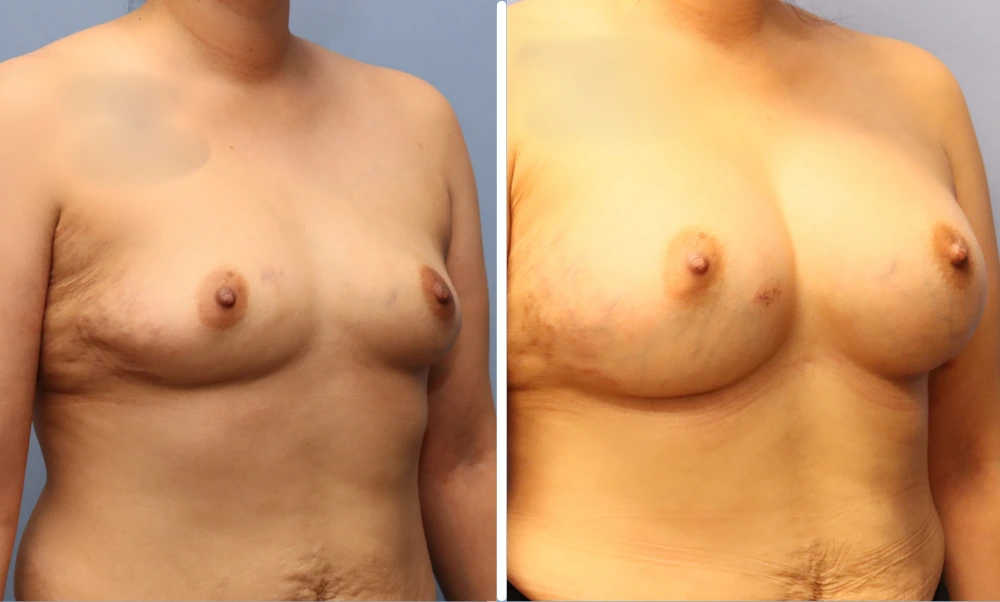 Before and after breast augmentation, frontal view showing natural-looking volume and symmetry