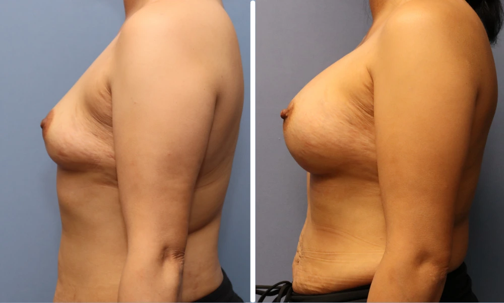 Before and after breast augmentation, side profile view showing enhanced projection and shape