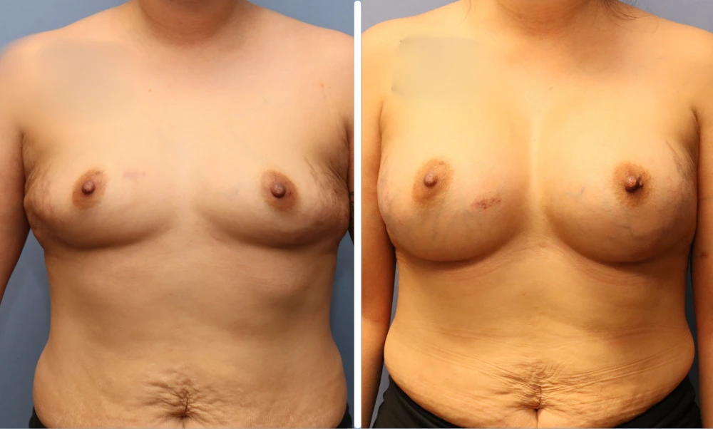 Before and after breast augmentation, frontal view showing increased size and upper pole fullness