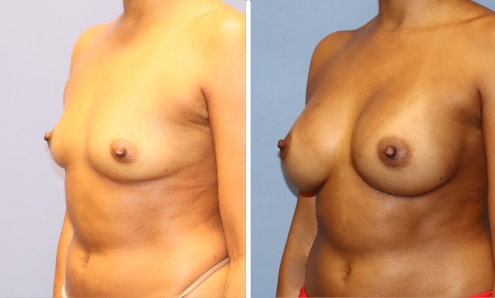 Before and after breast augmentation, oblique view