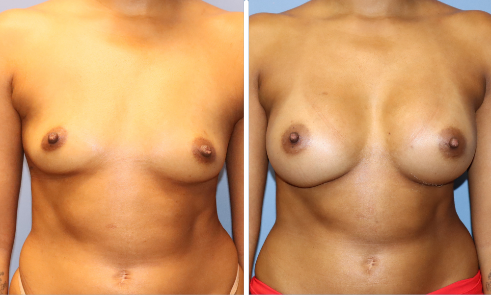 Before and after breast augmentation, front view