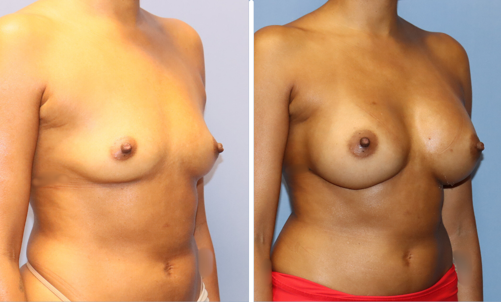 Before and after breast augmentation, oblique view