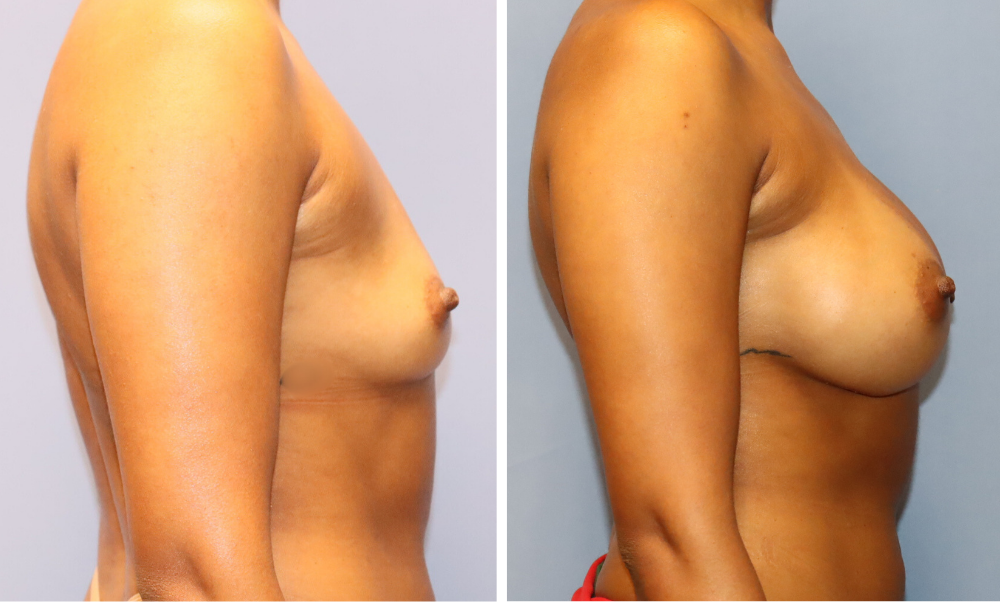 Before and after breast augmentation, side view