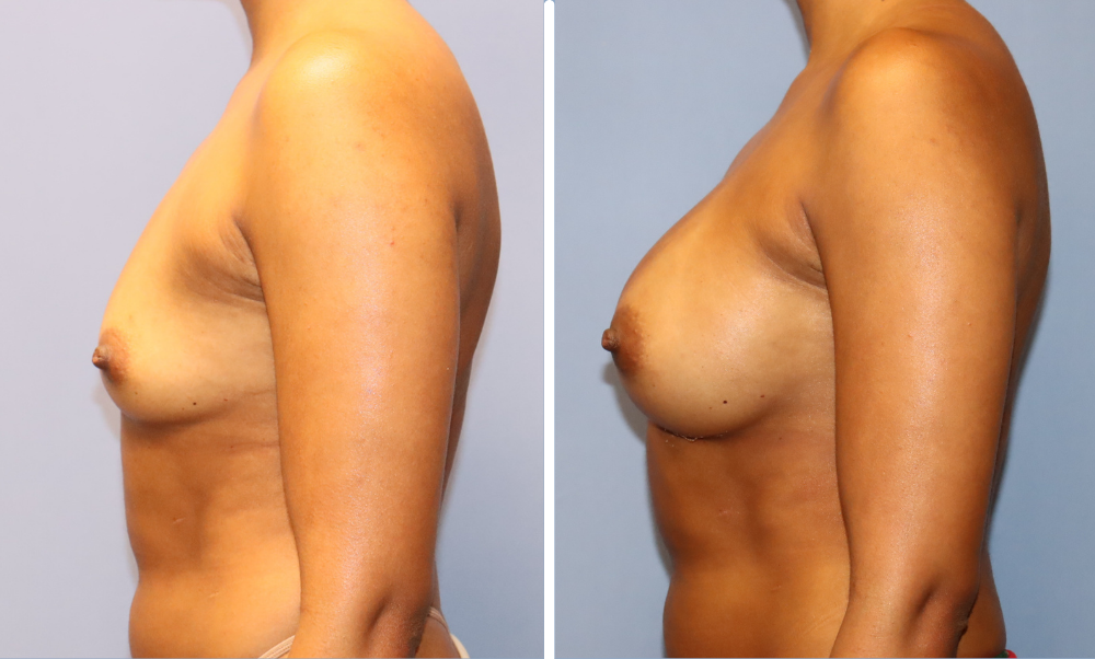 Before and after breast augmentation, side view