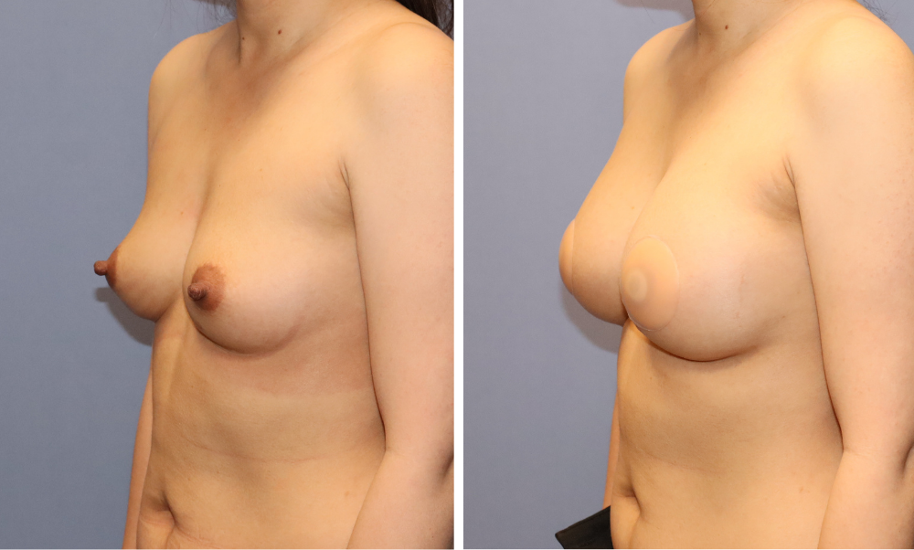 Before and after breast augmentation results, side profile views