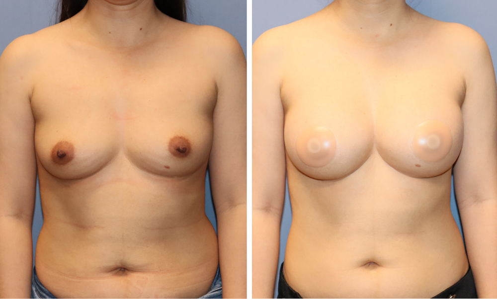Before and after breast augmentation results, frontal views