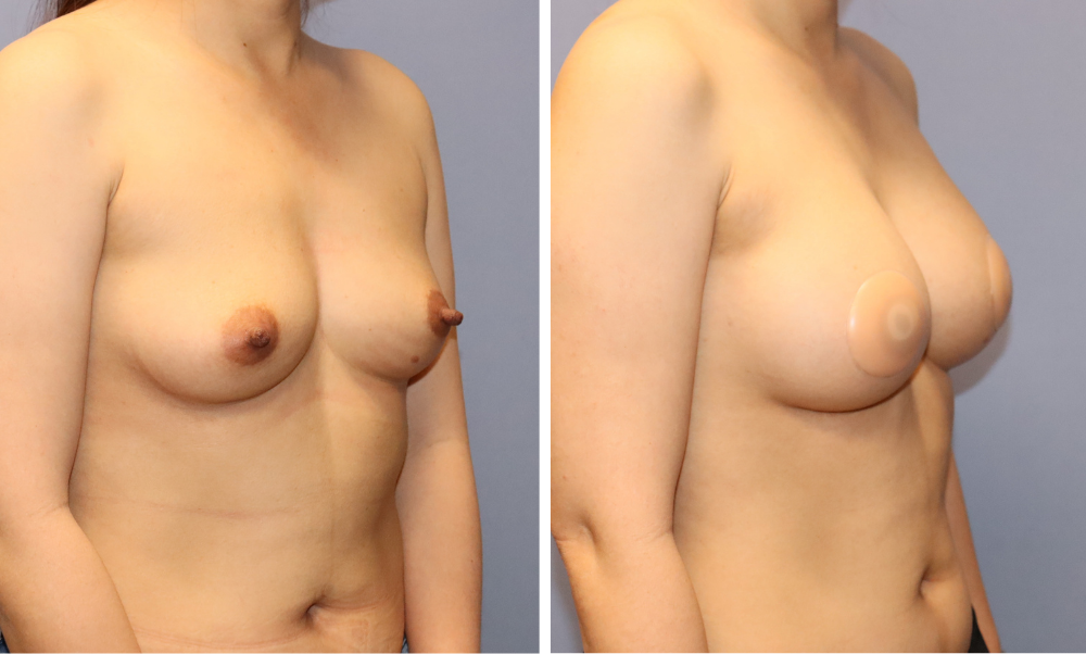 Before and after breast augmentation results, frontal and oblique views