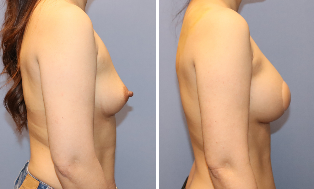 Before and after breast augmentation results, side profile views
