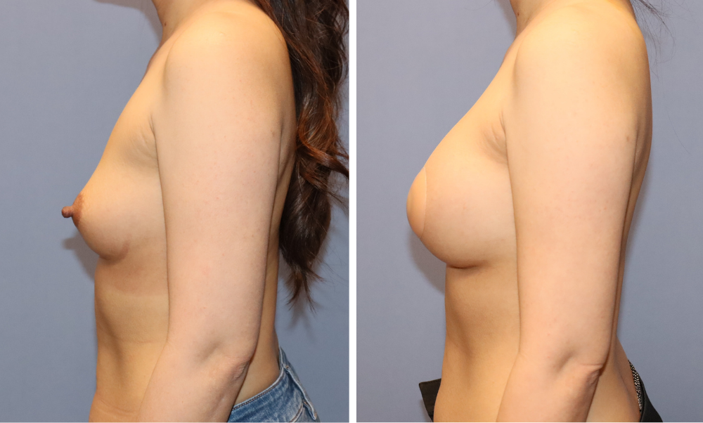 Before and after breast augmentation results, side profile views