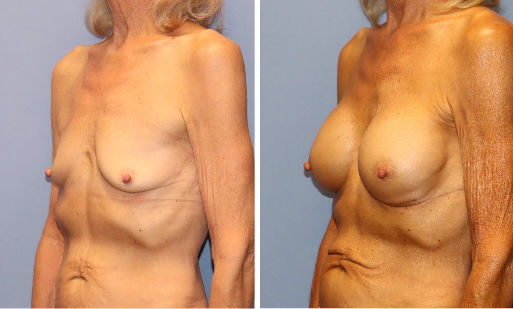 Breast augmentation before and after, front view showing enhanced shape and symmetry
