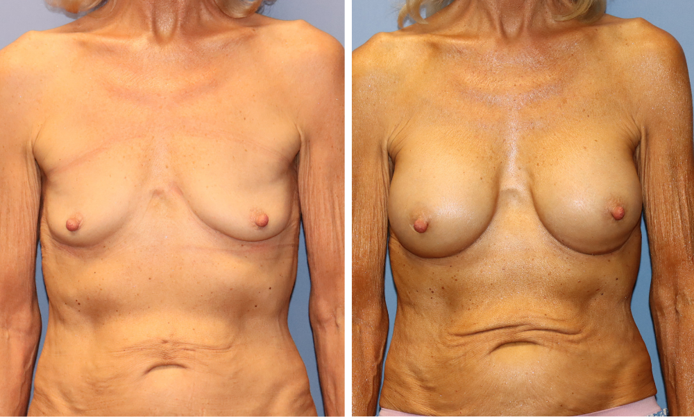 Breast augmentation before and after, front view demonstrating fuller appearance and improved proportion