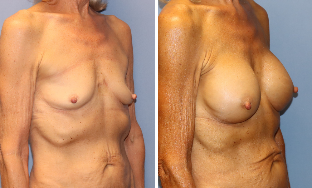 Breast augmentation before and after, side view showing enhanced contour and projection