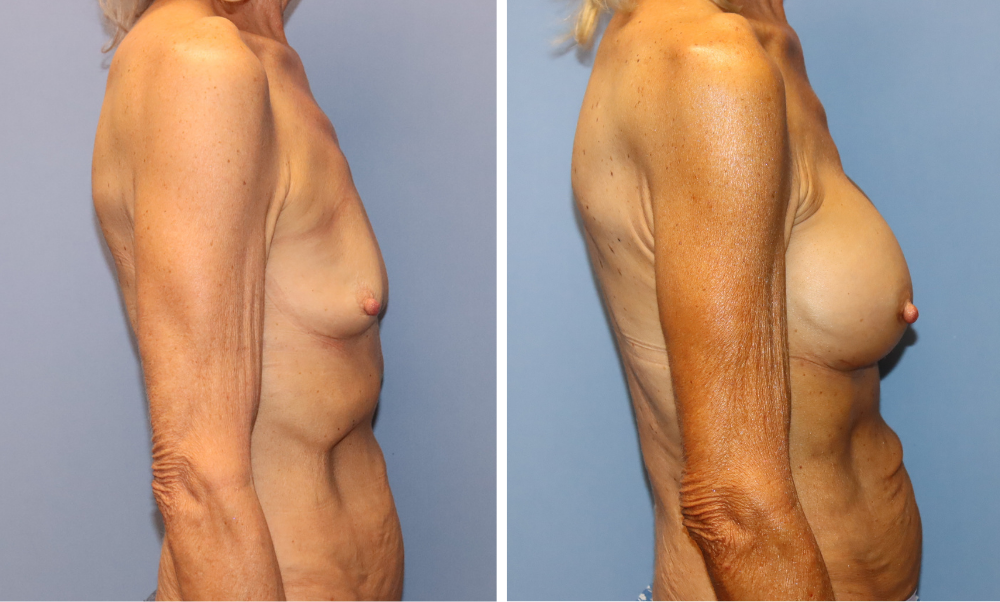 Before and after breast augmentation results, oblique side profile views