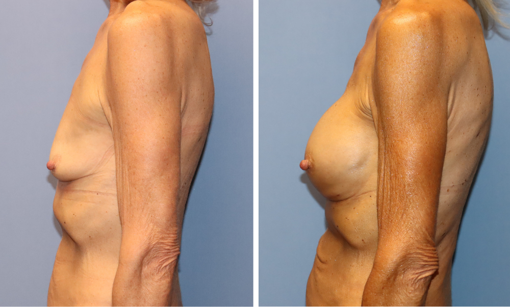 Breast augmentation before and after, side view showing increased volume and lift