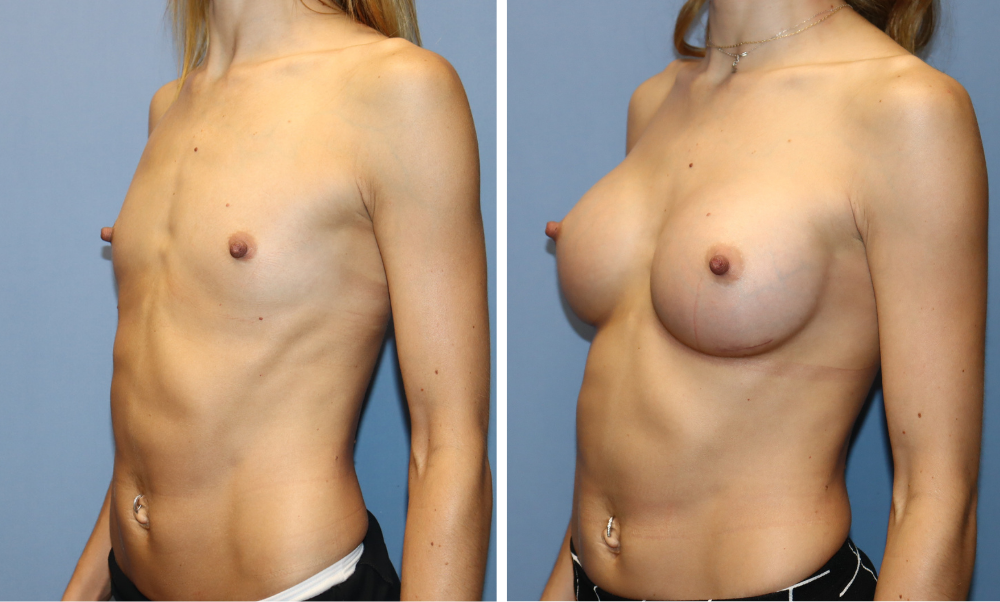 Before and after breast augmentation, left side profile view