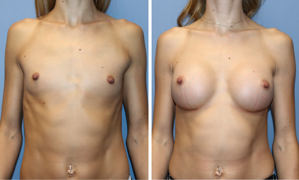 Before and after breast augmentation, frontal view