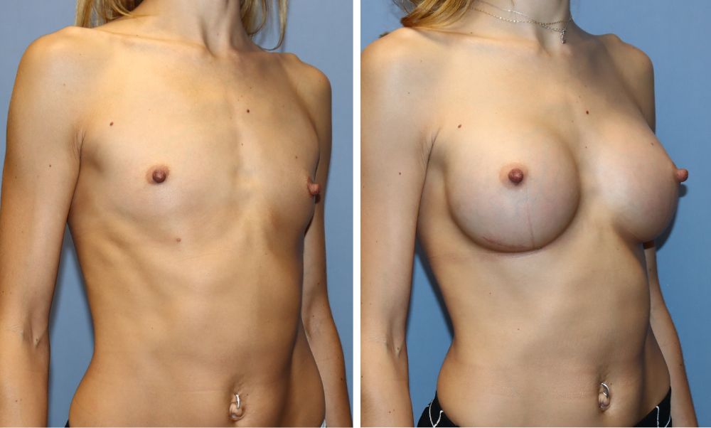 Before and after breast augmentation, left side profile view