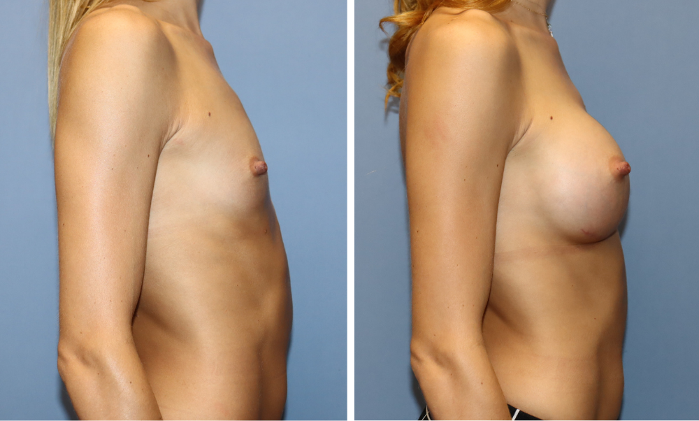 Before and after breast augmentation, right side profile view