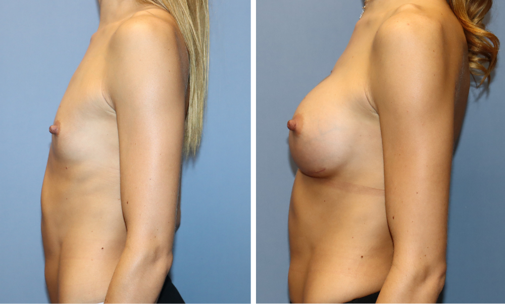 Before and after breast augmentation, left side profile view