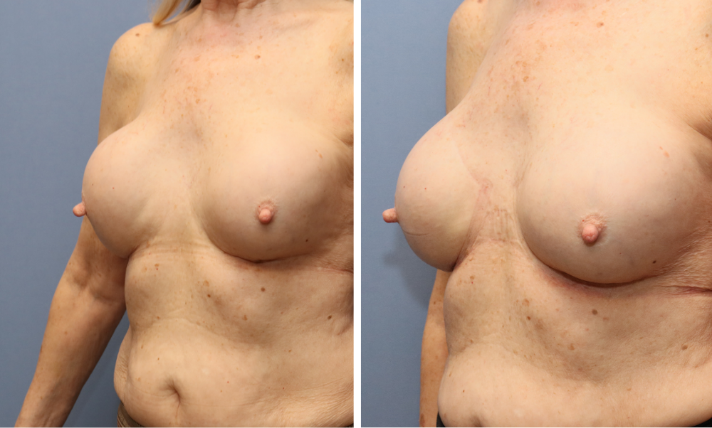Before and after side profile showing breast augmentation results