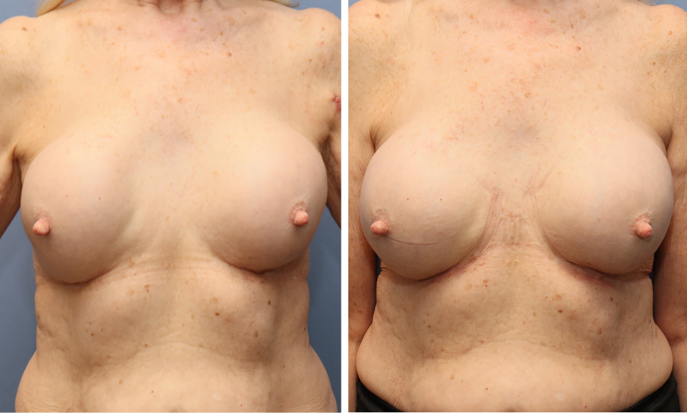 Before and after frontal view of breast augmentation results