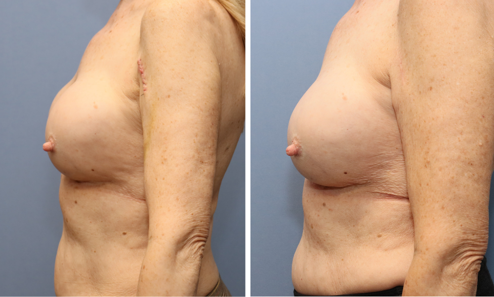 Before and after side view of breast augmentation results