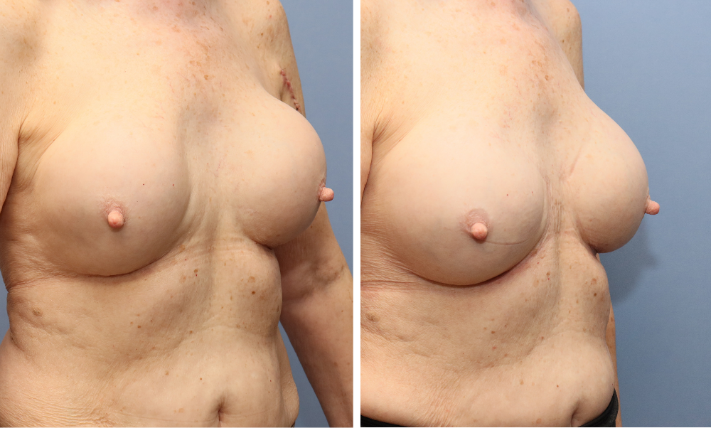 Before and after three-quarter view of breast augmentation results