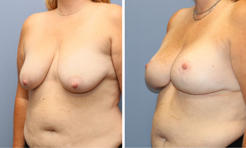 Before and after front view showing breast augmentation results