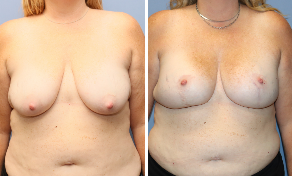 Before and after front view showing breast augmentation results
