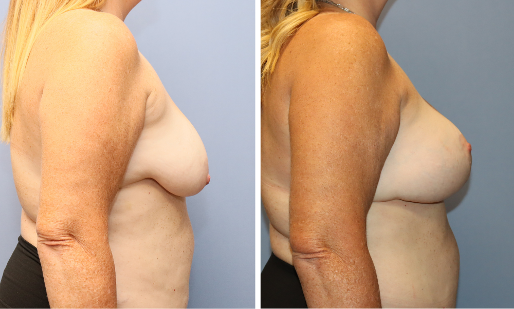 Before and after side profile showing breast augmentation results